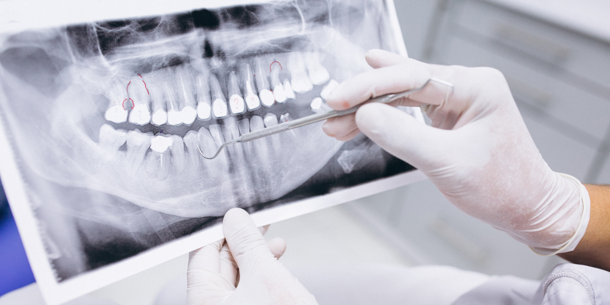 4 Tecnologías Innovadoras en la Endodoncia Moderna